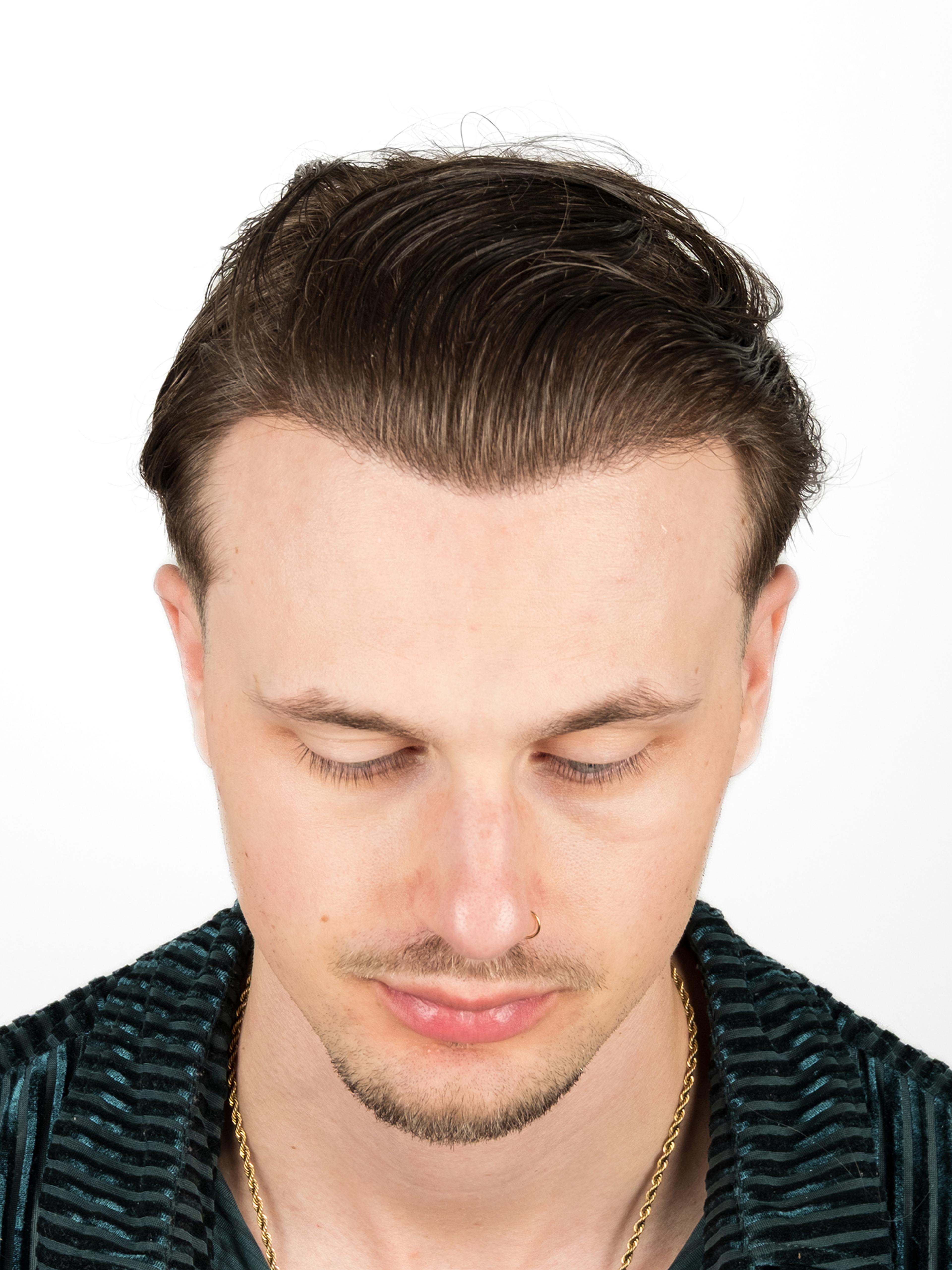 After – FUE & DHI