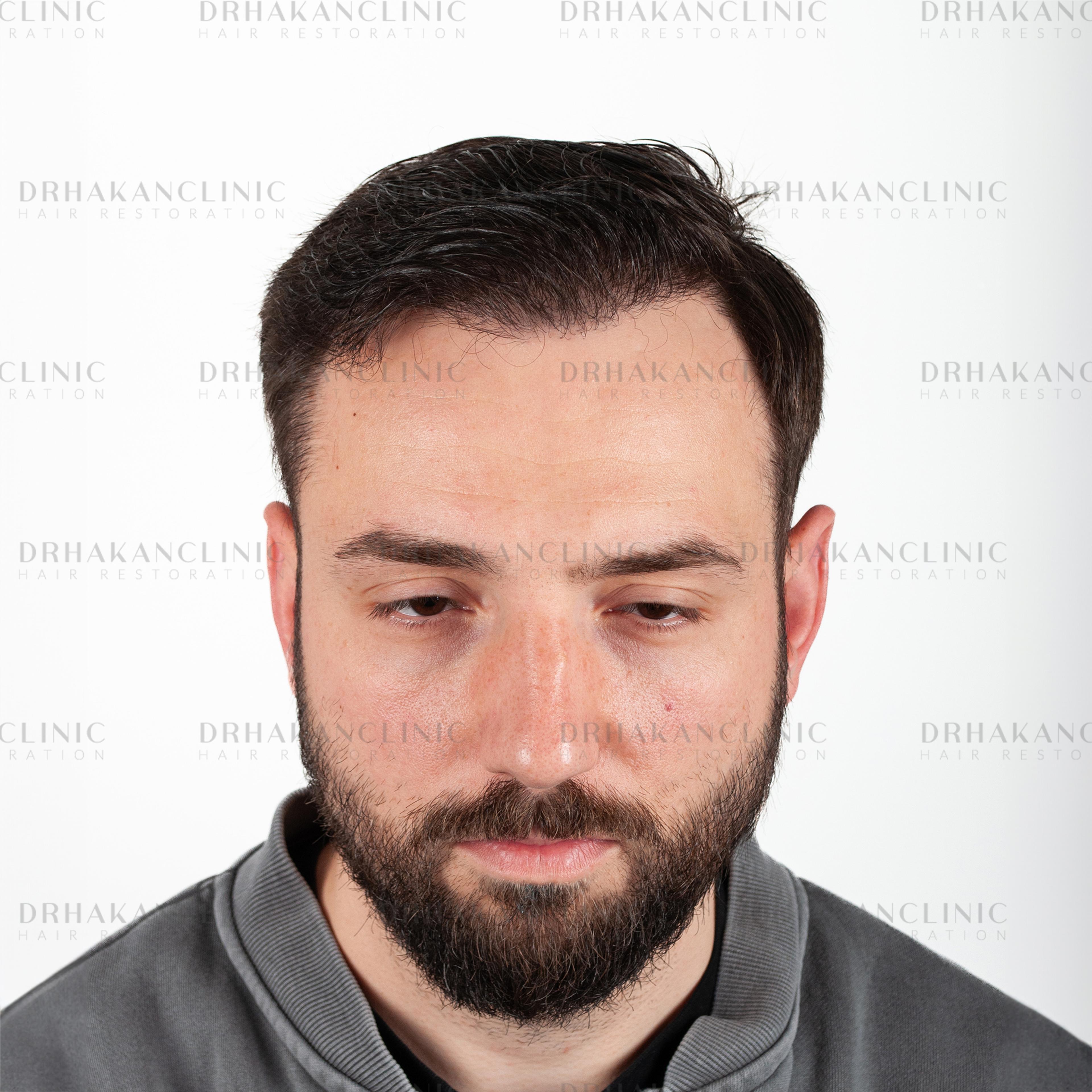 After – FUE & DHI