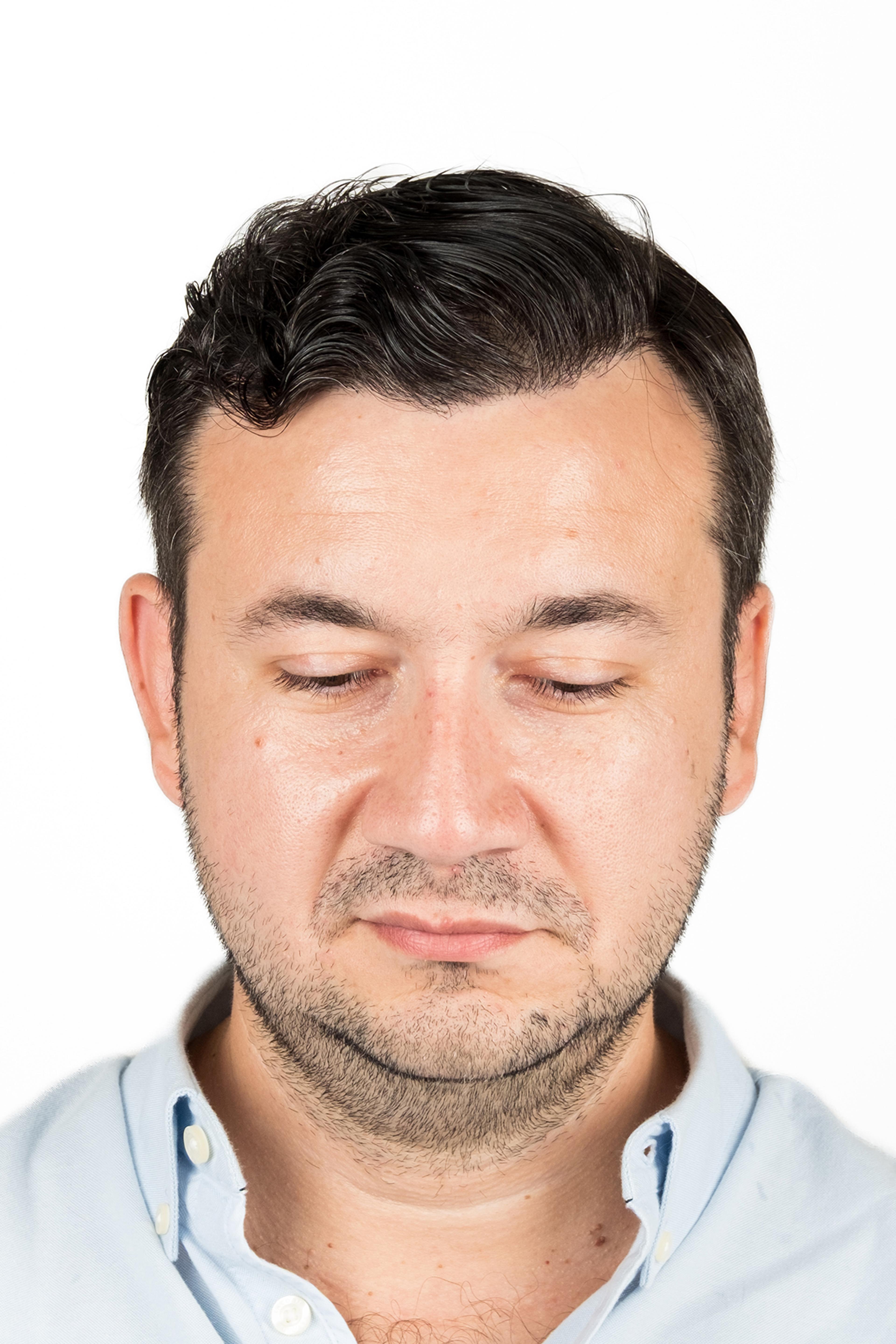 After – FUE & DHI