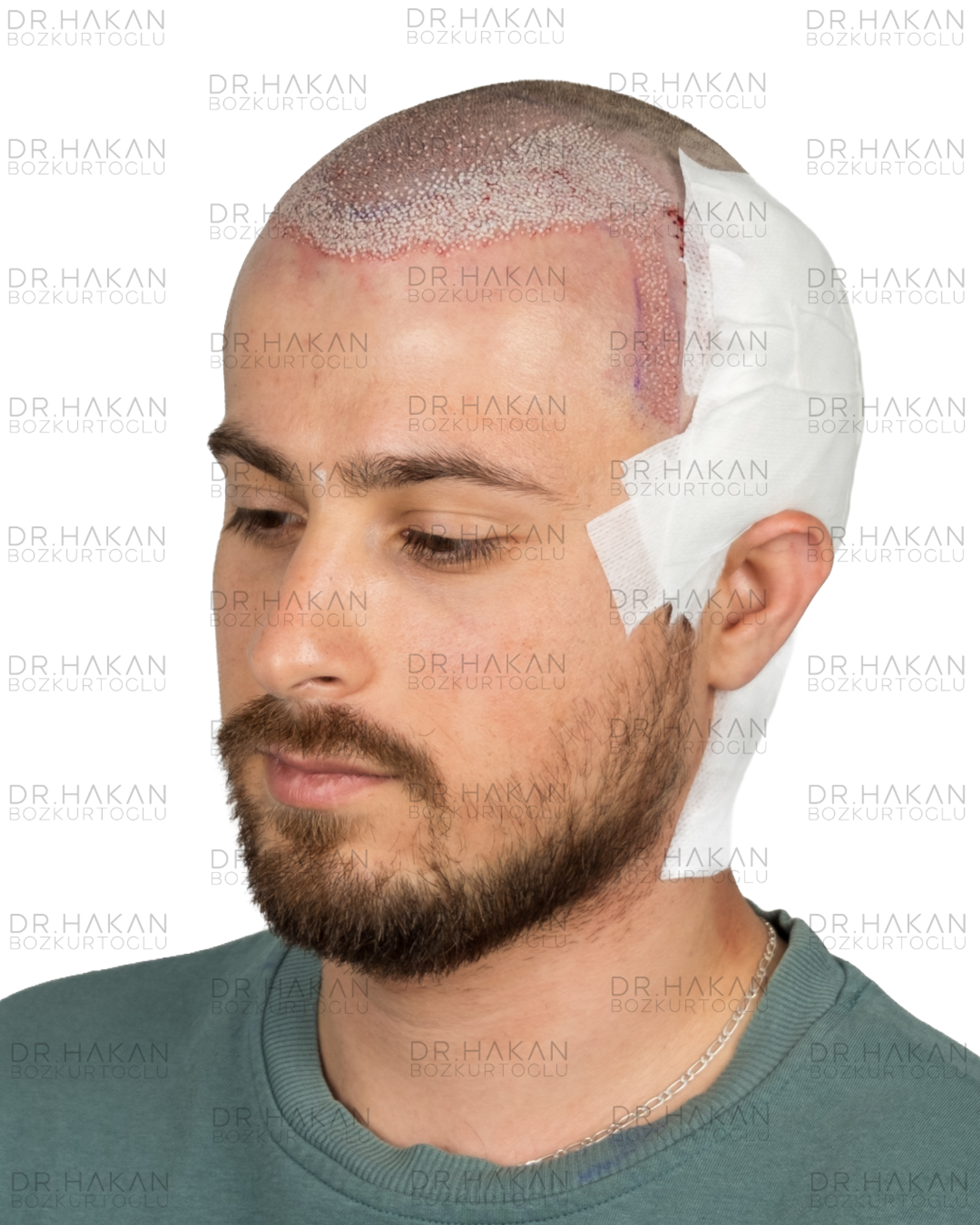 post-op