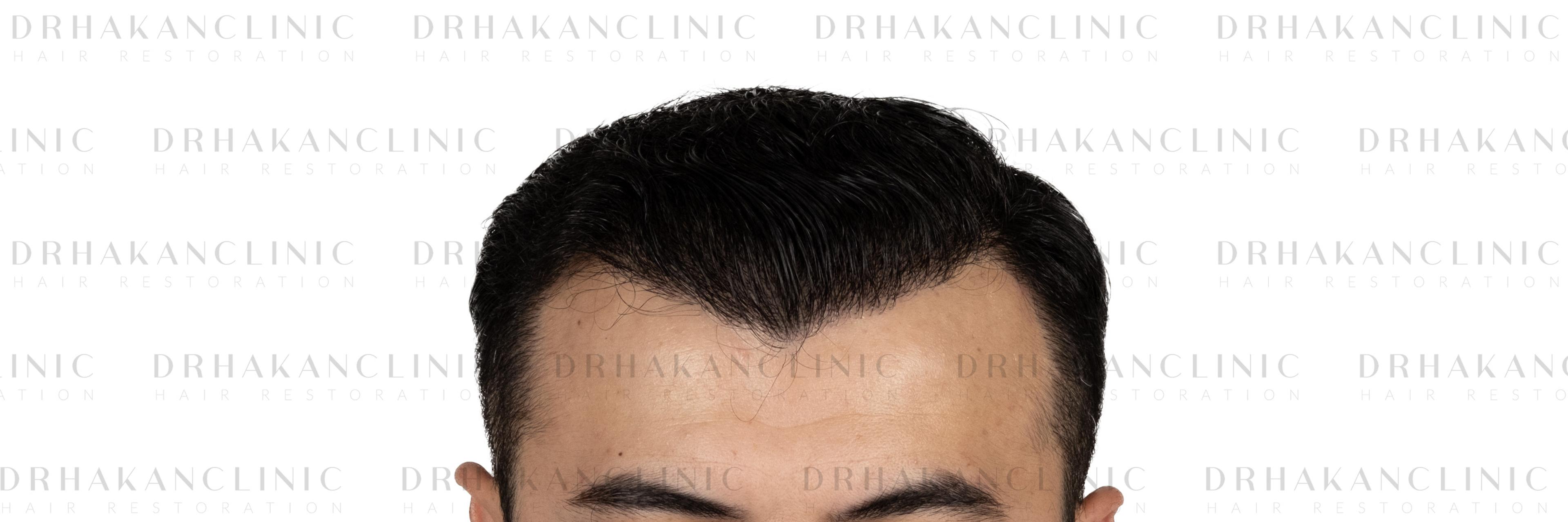 After – FUE & DHI