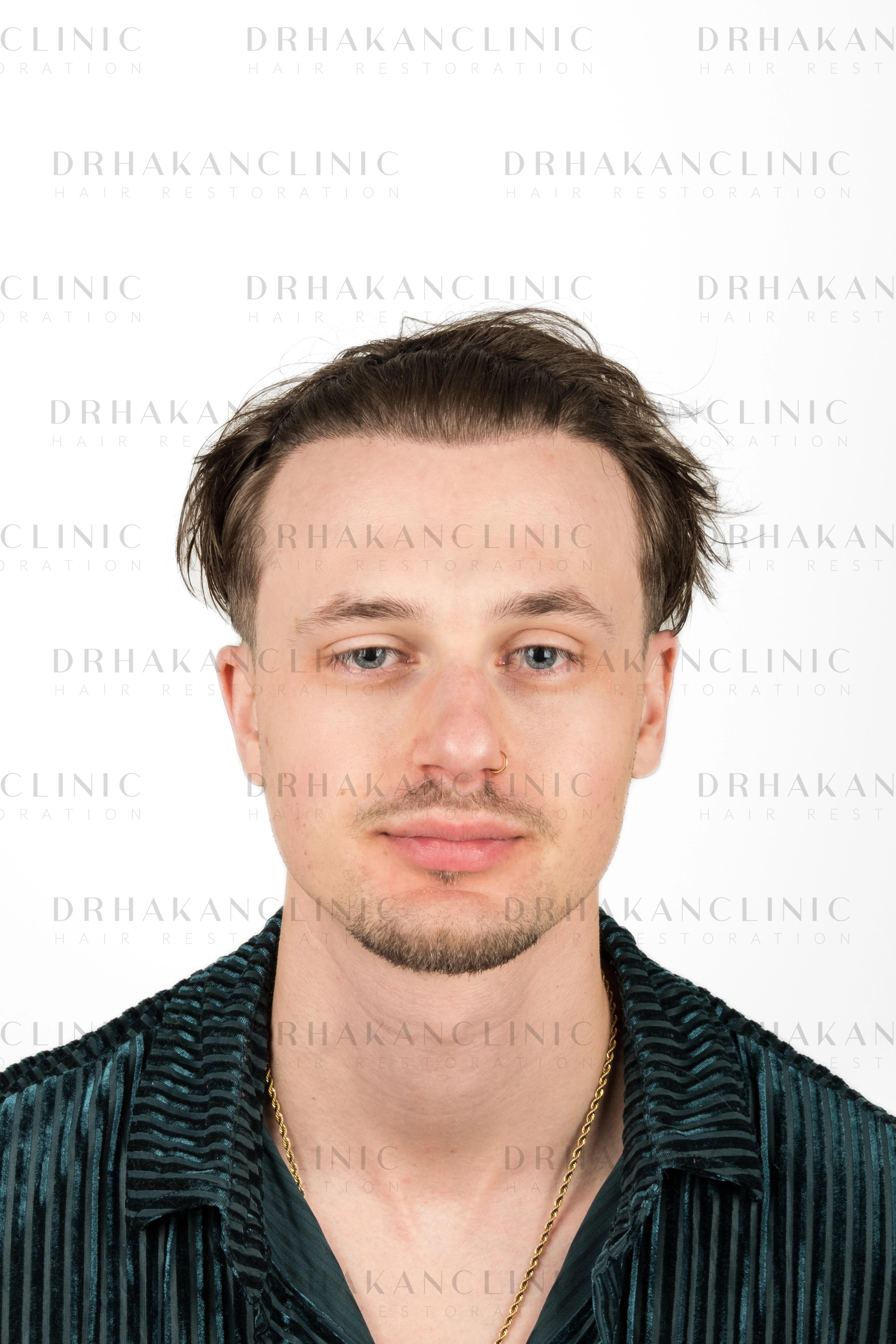 35 months post-op