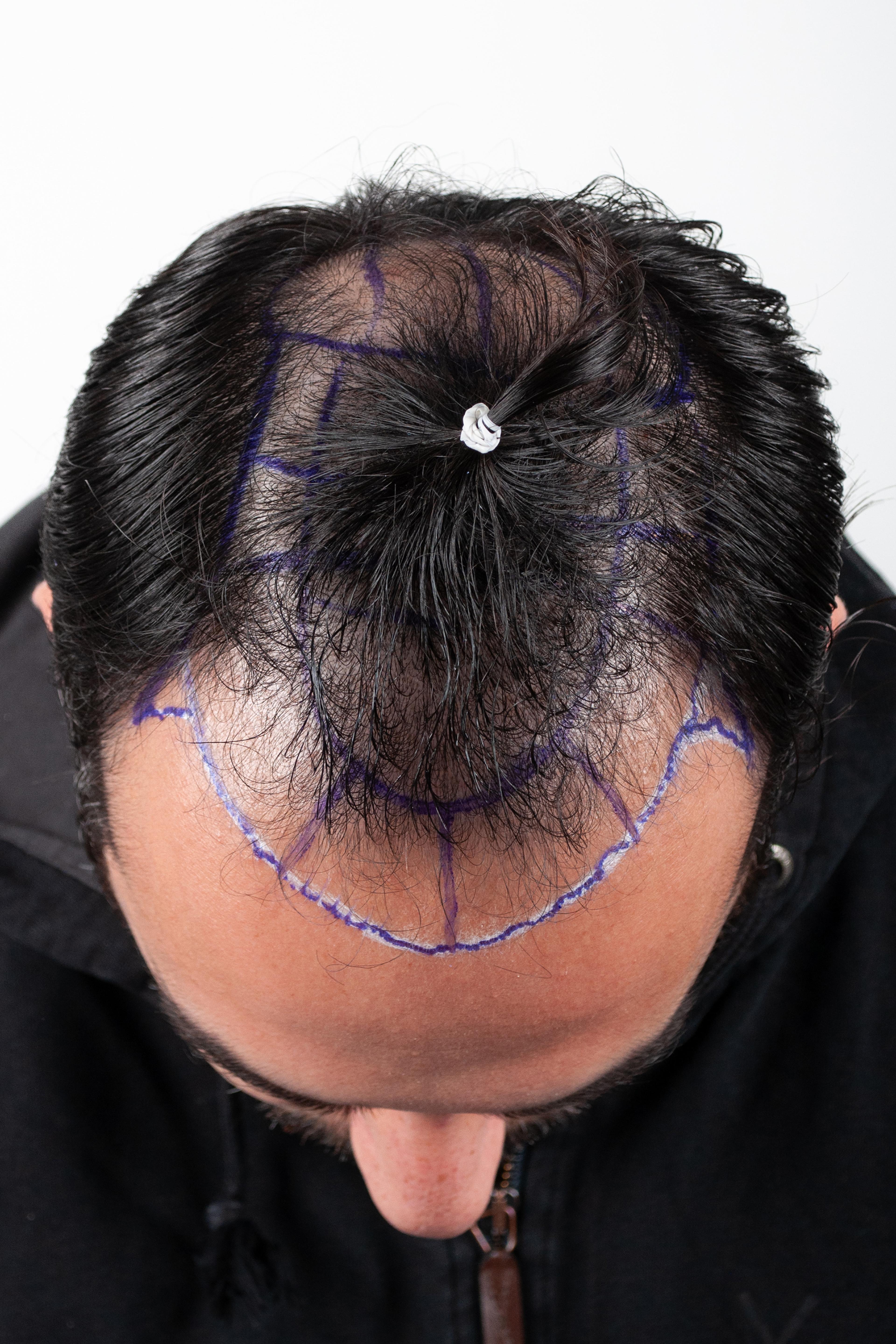 Before – FUE & DHI