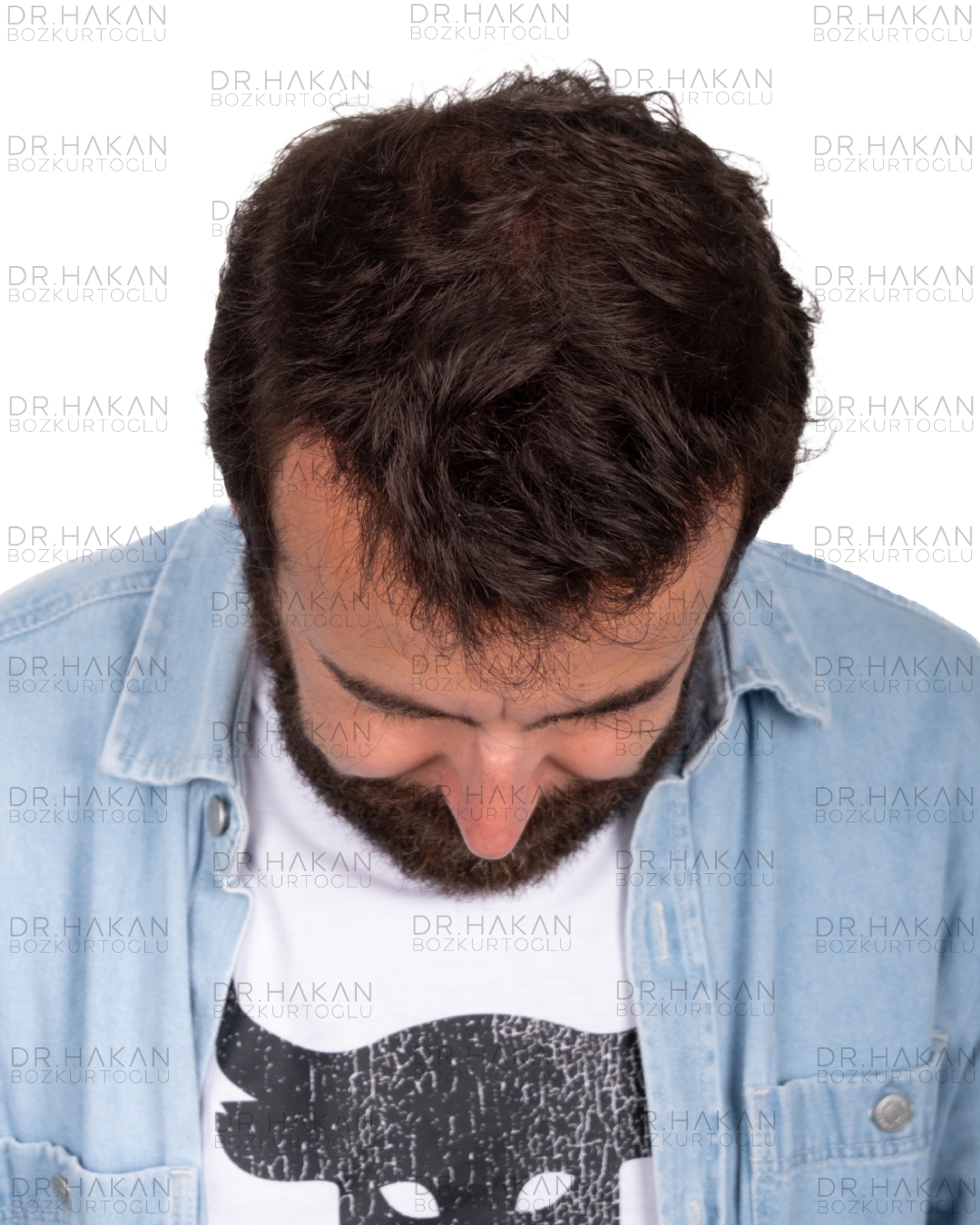 12 months dry hair