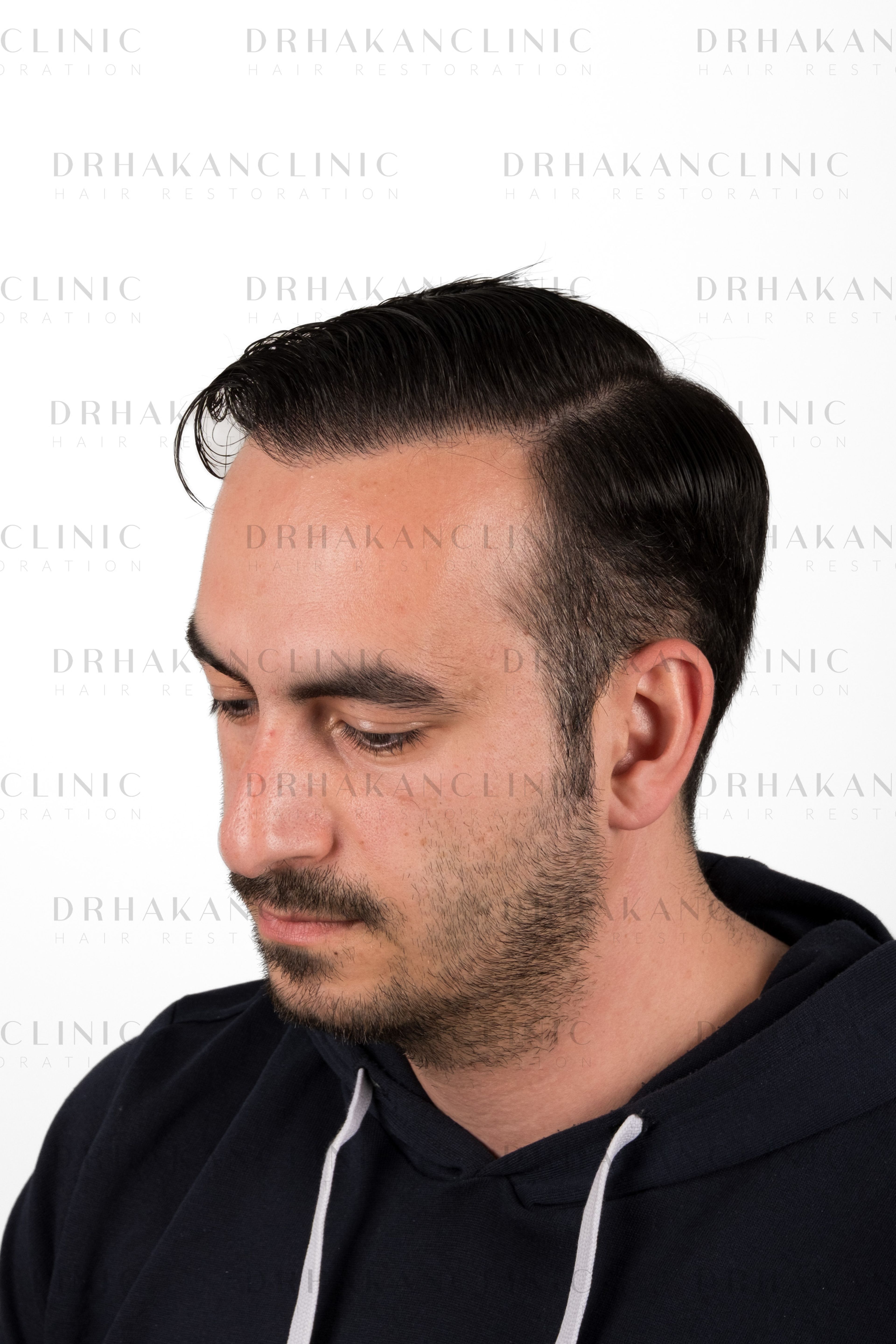 12 months post-op wet hair