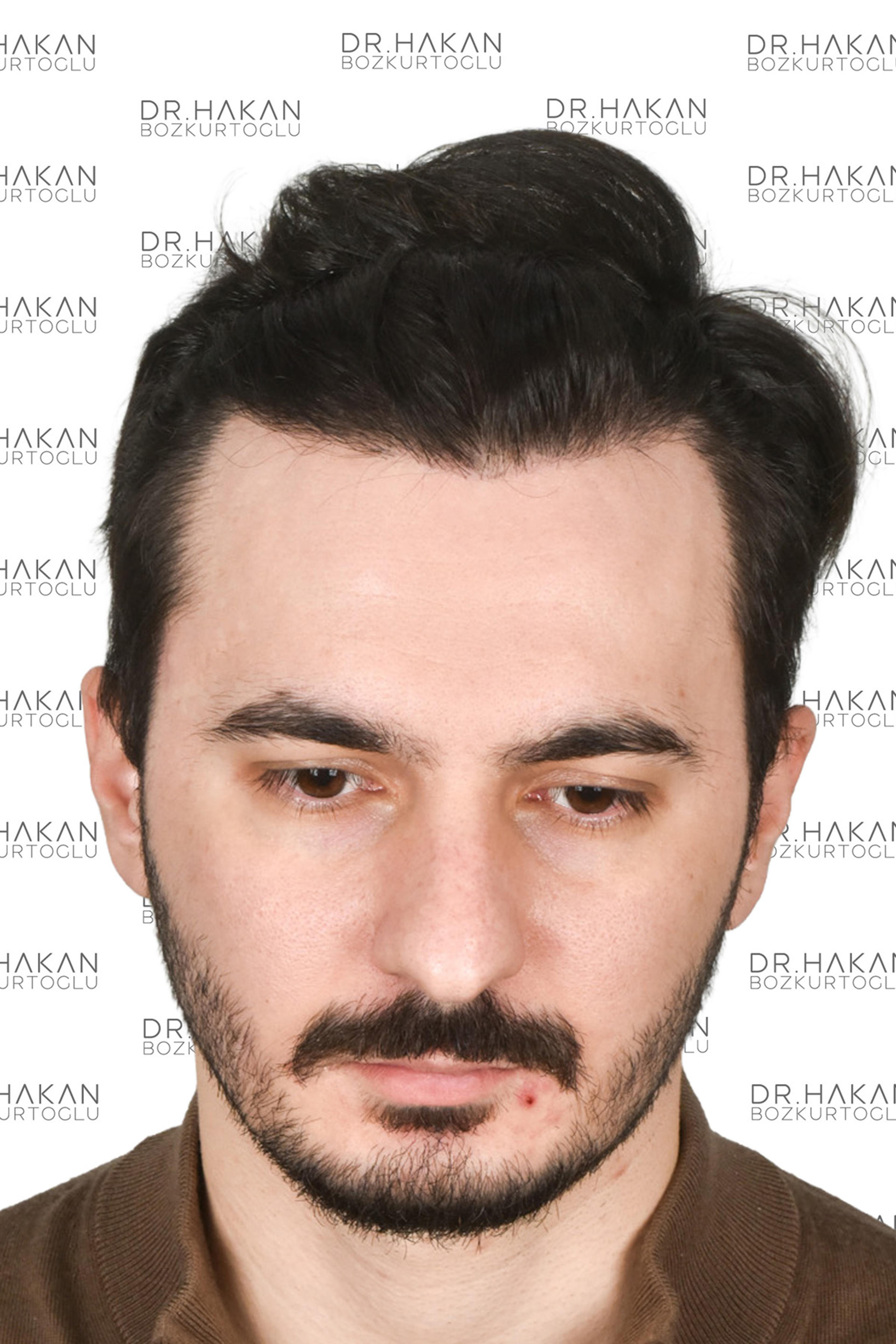 After – FUE & DHI