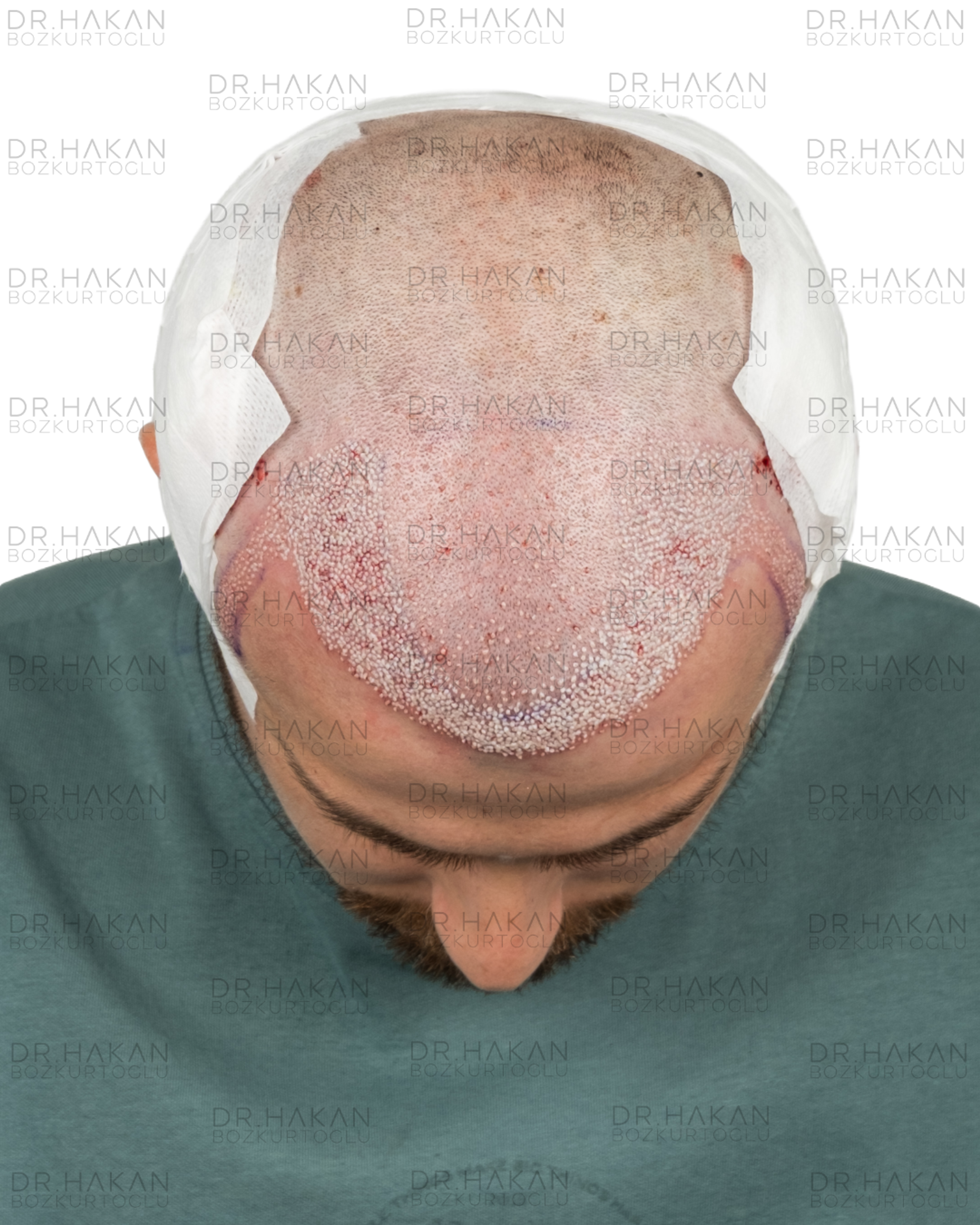 post-op