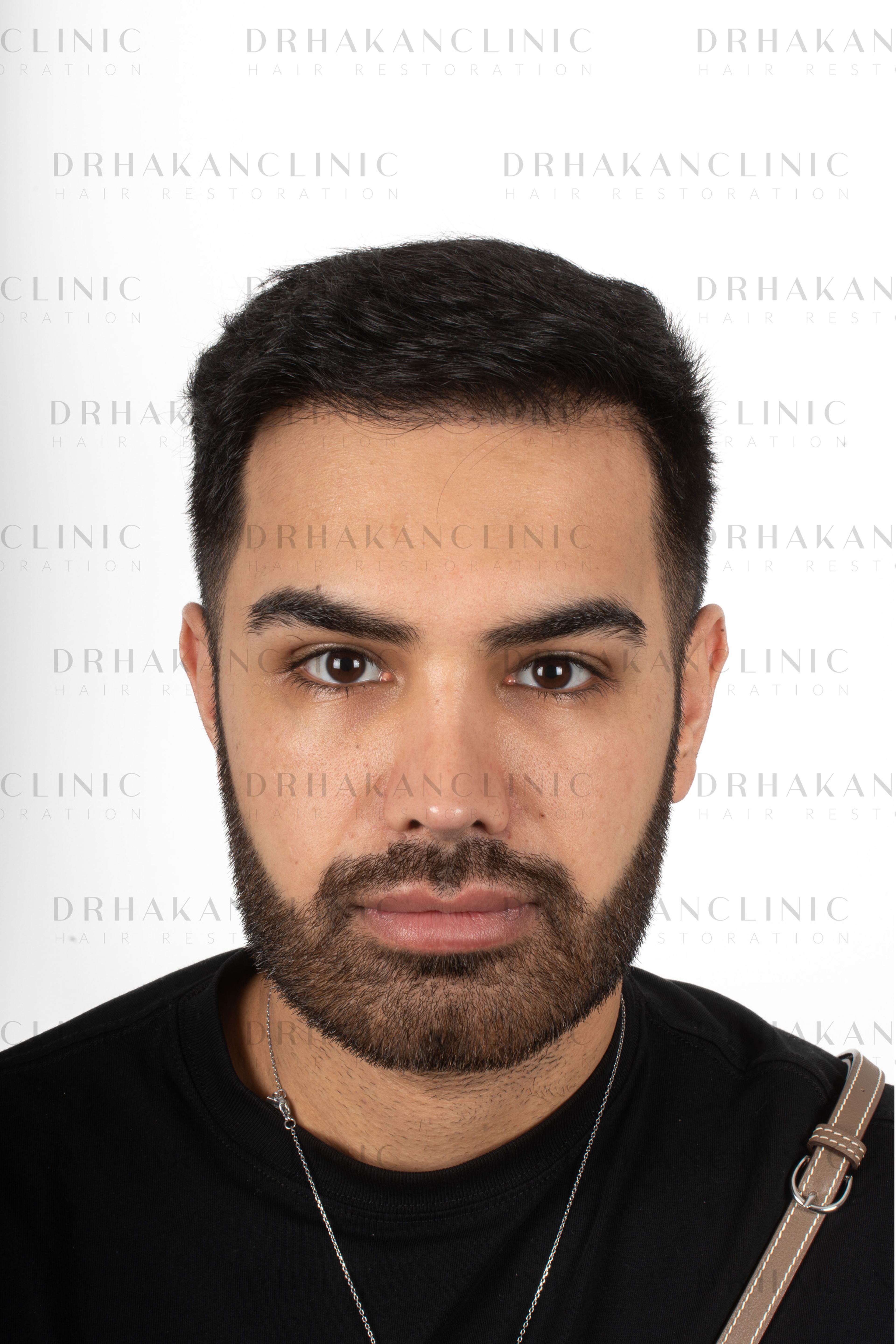 9 months post-op