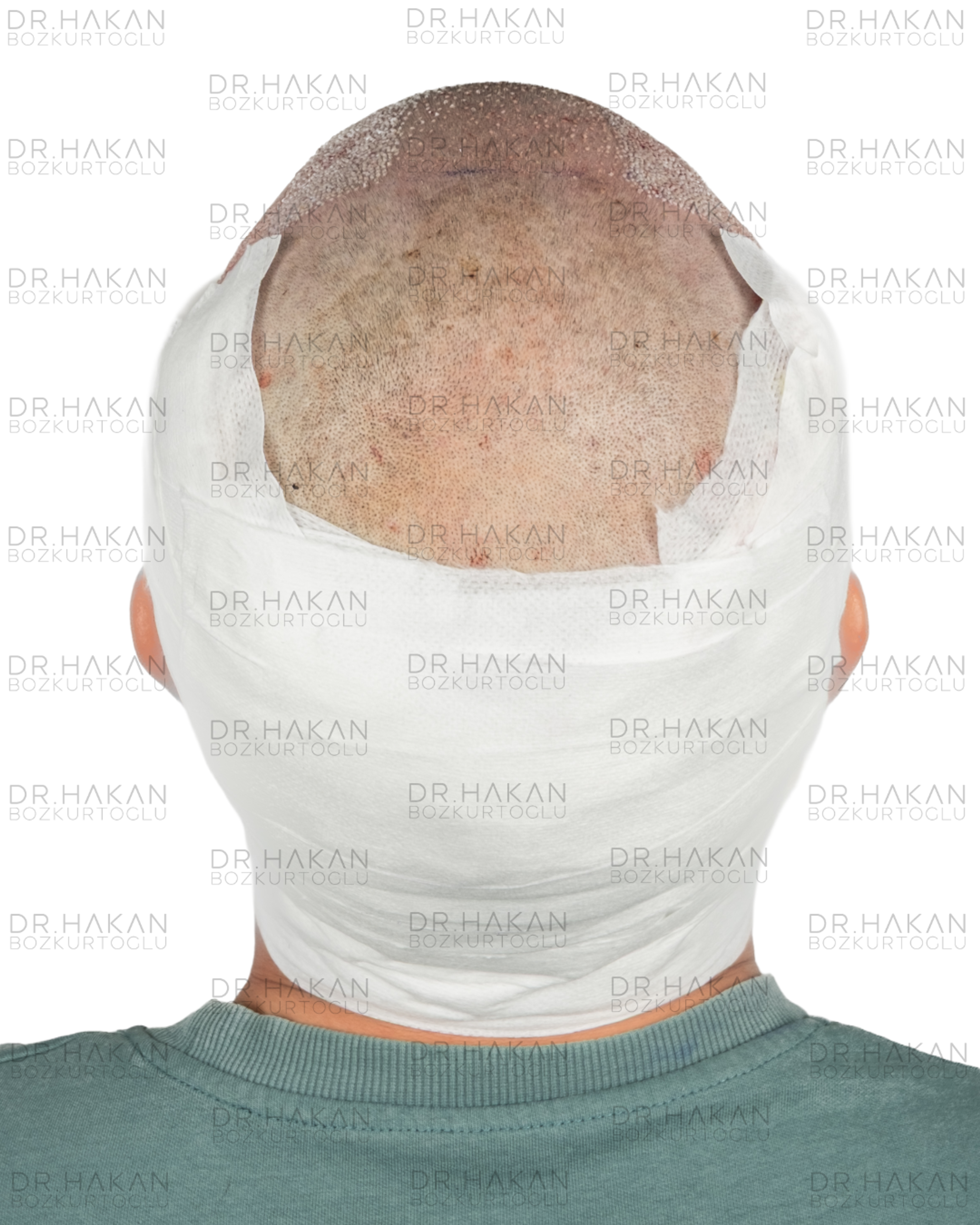 post-op