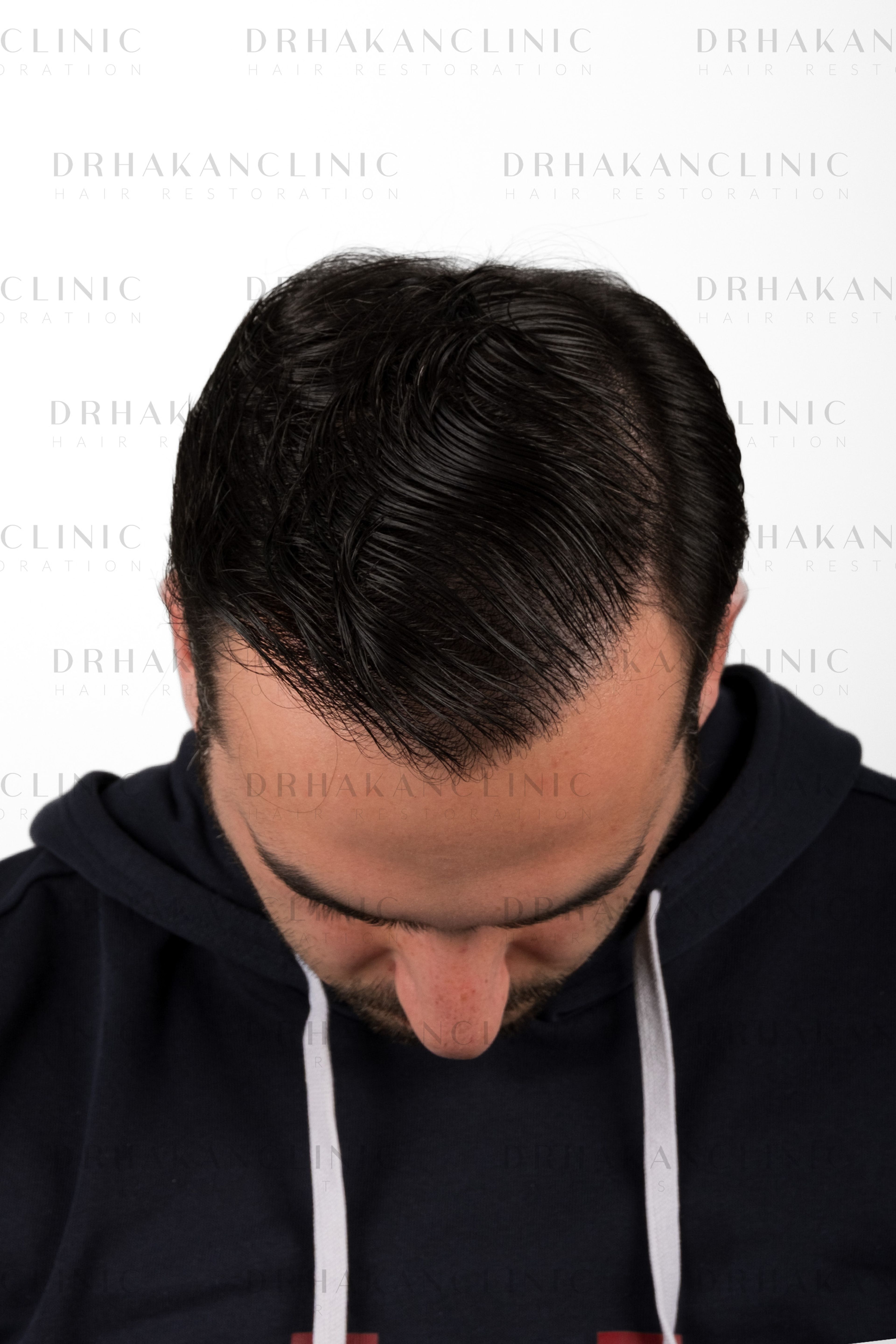 12 months post-op wet hair