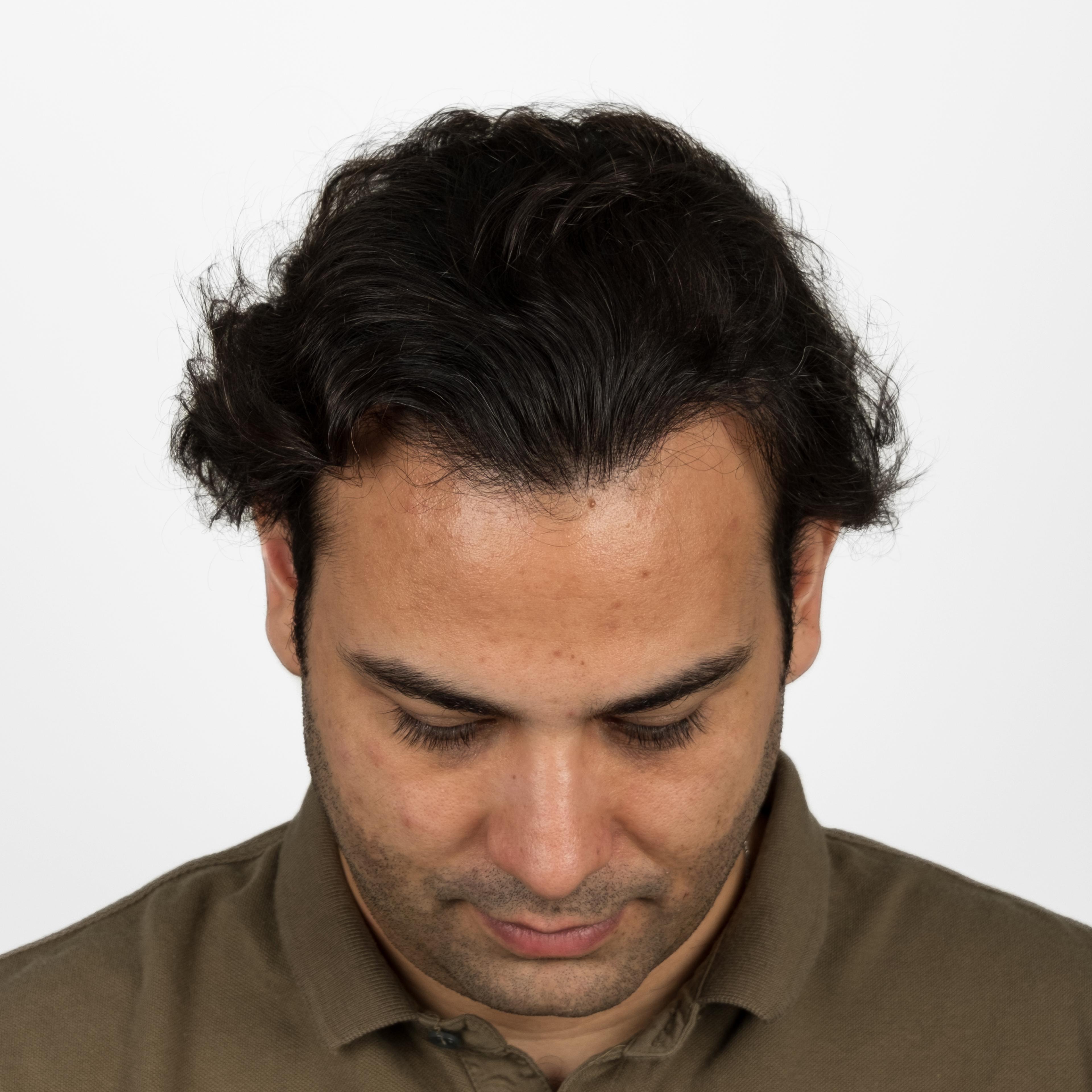 After – FUE & DHI