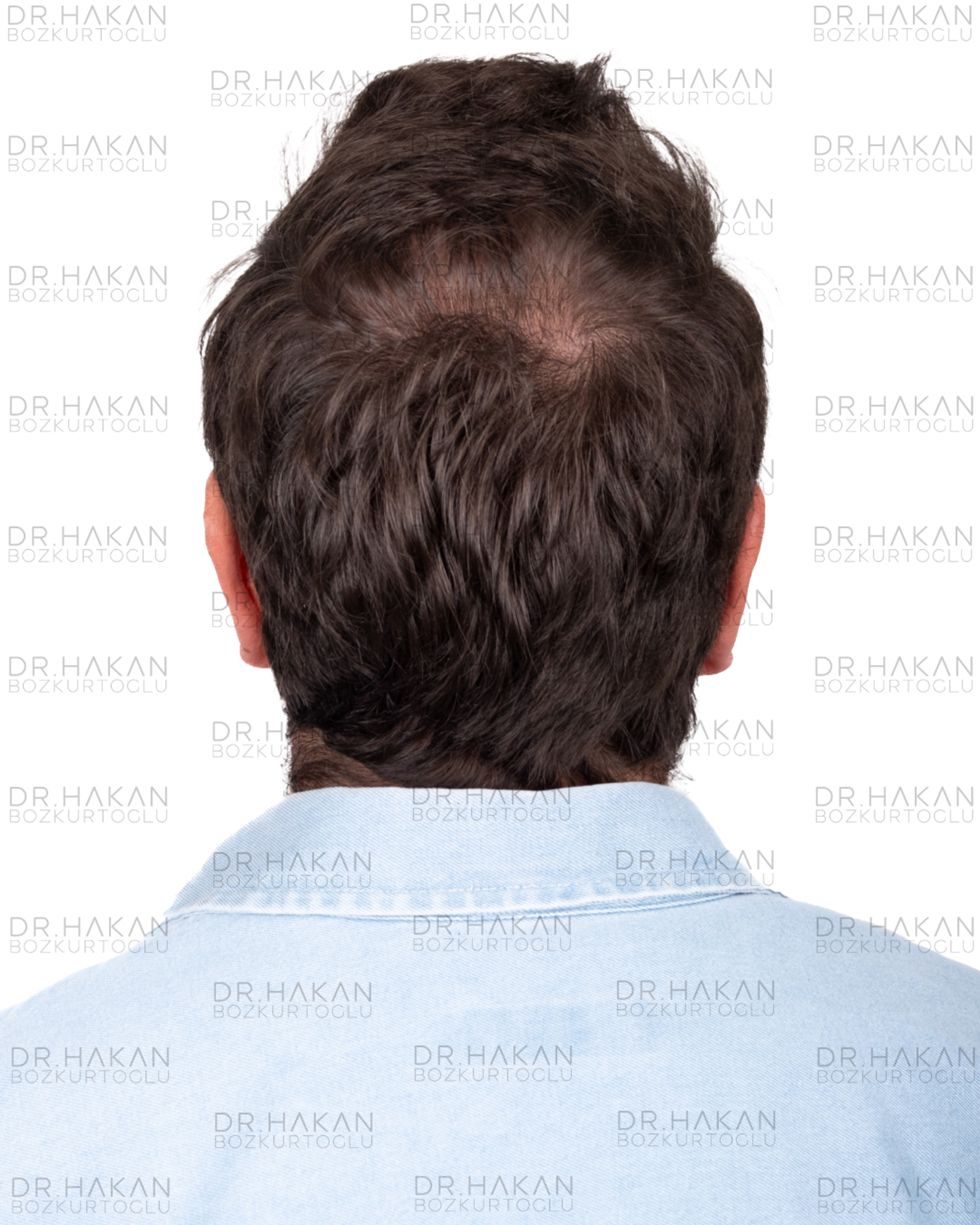 12 months dry hair