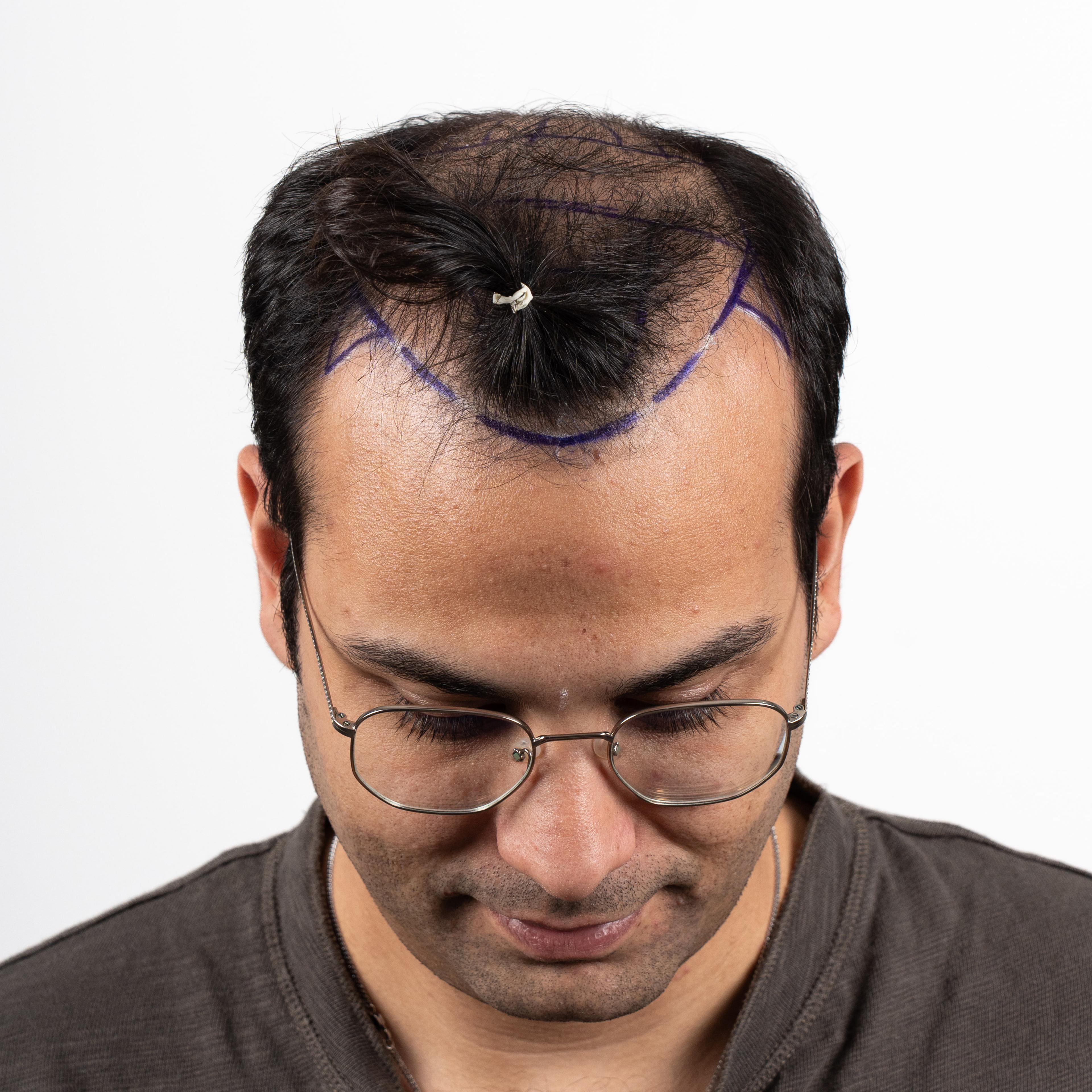 Before – FUE & DHI
