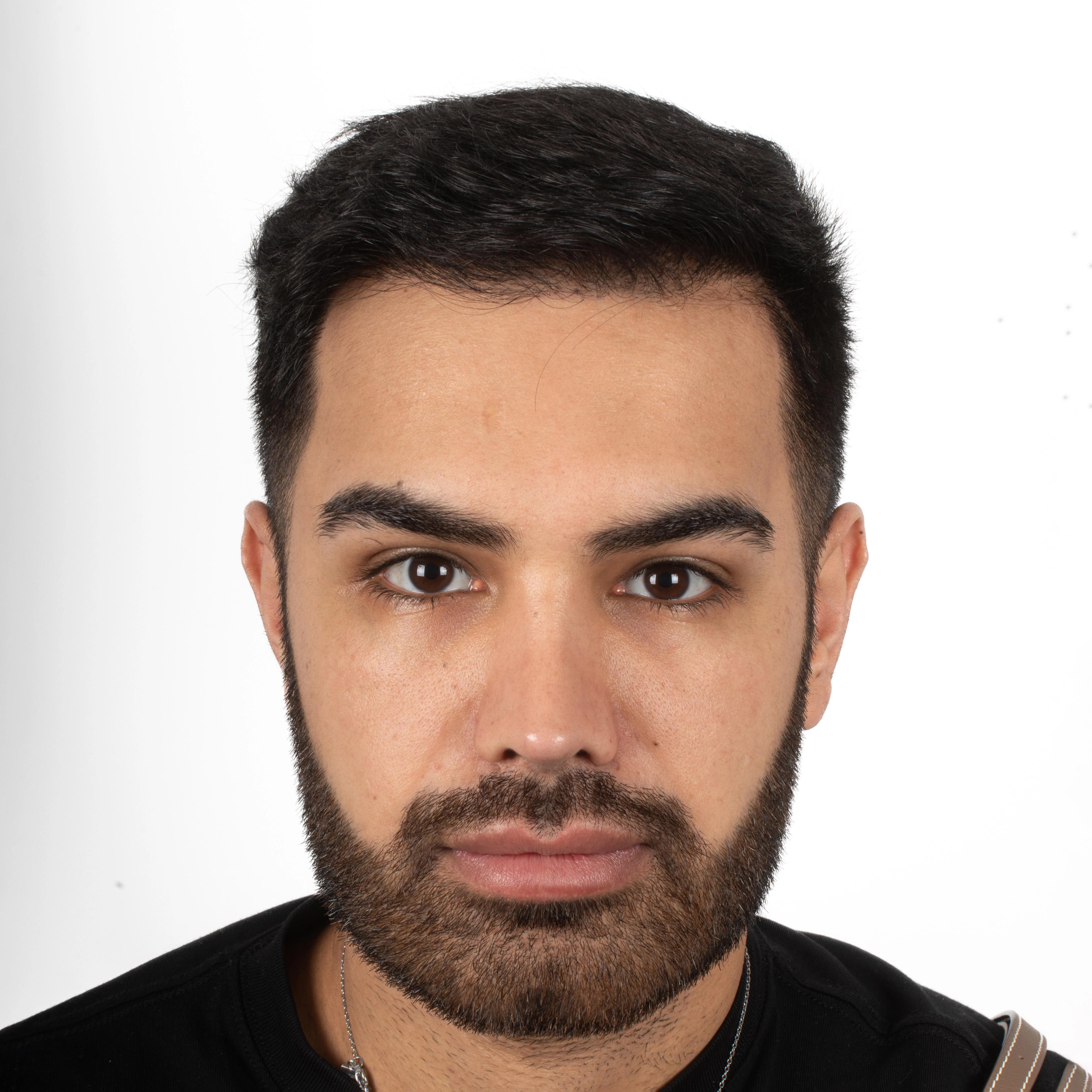 After – FUE & DHI
