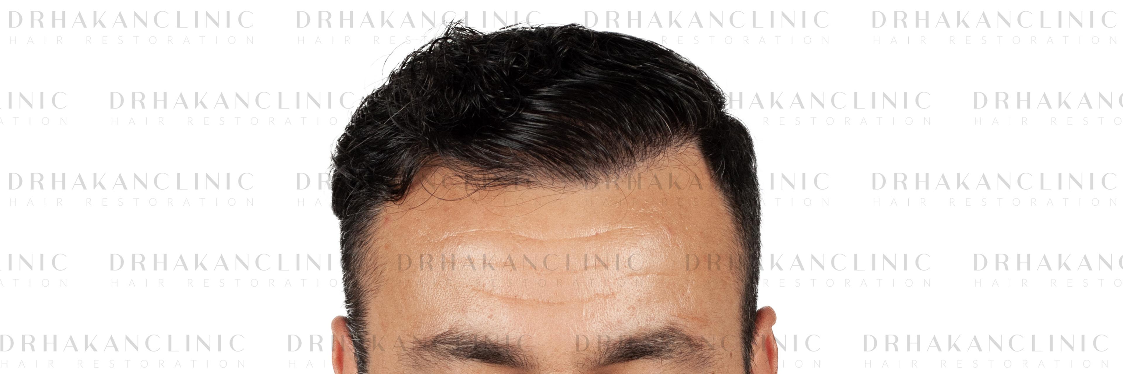 After – FUE & DHI