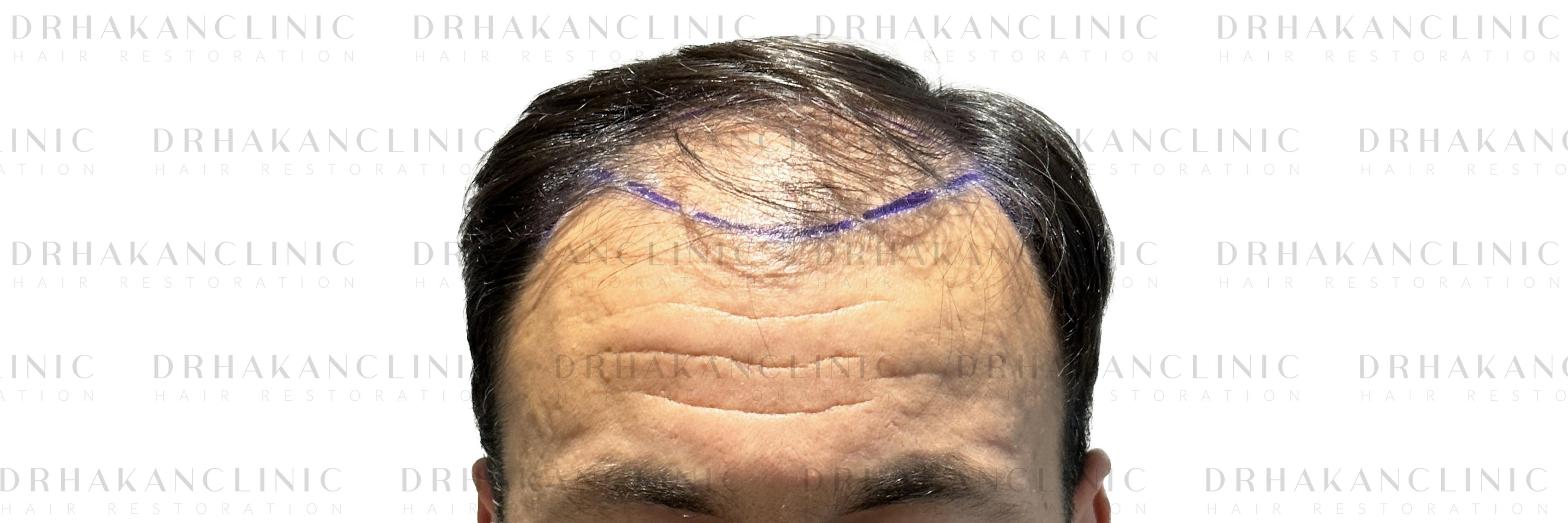 Before – FUE & DHI