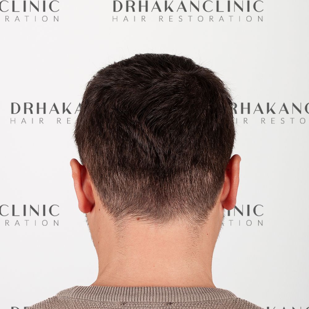 Fully healed donor area after FUE hair transplant, showing no visible scarring and healthy hair regrowth