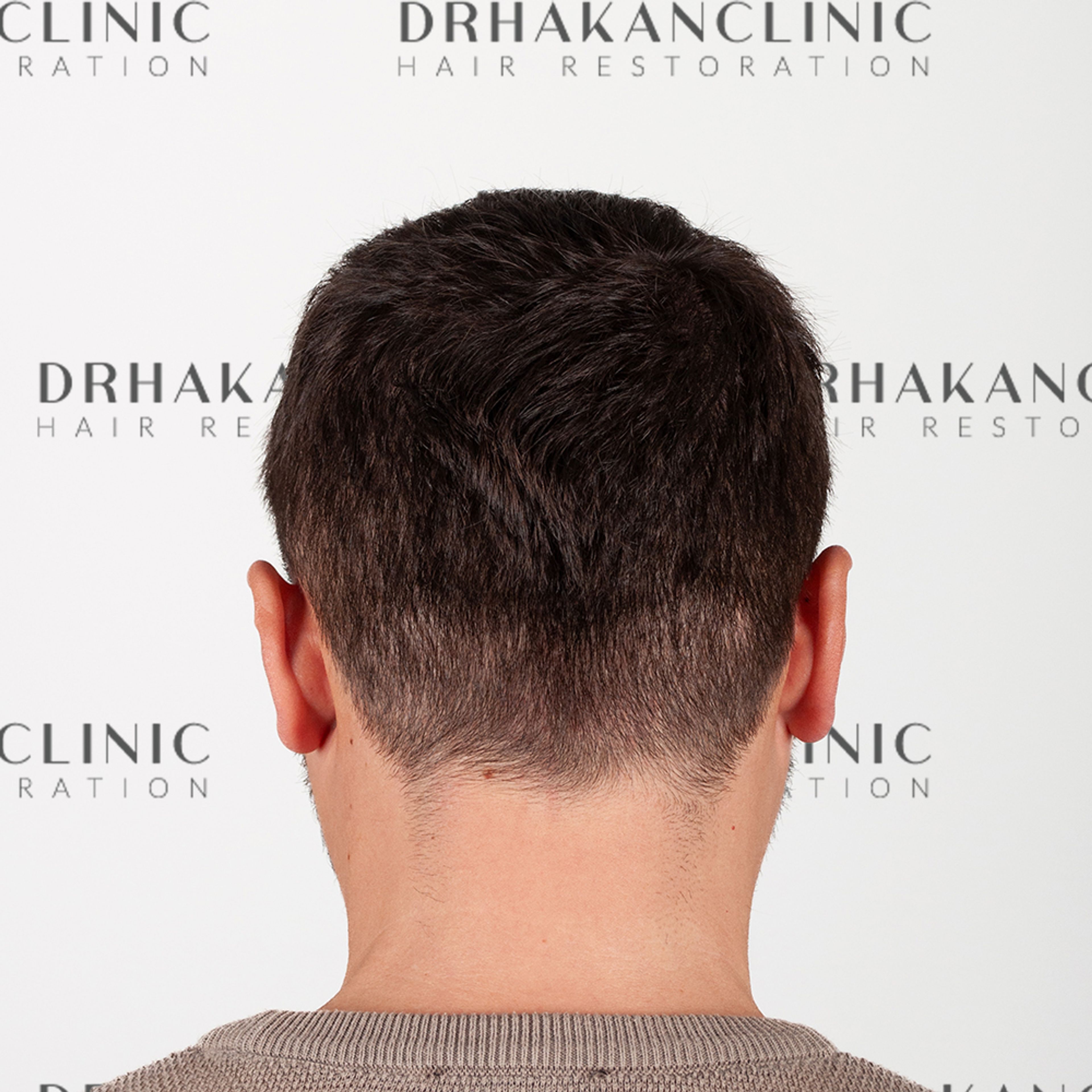 Fully healed donor area after FUE hair transplant, showing no visible scarring and healthy hair regrowth
