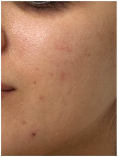 Acne Facial before — Persistent Acne, Comedones, Active Acne, Inflammatory Acne, front view
