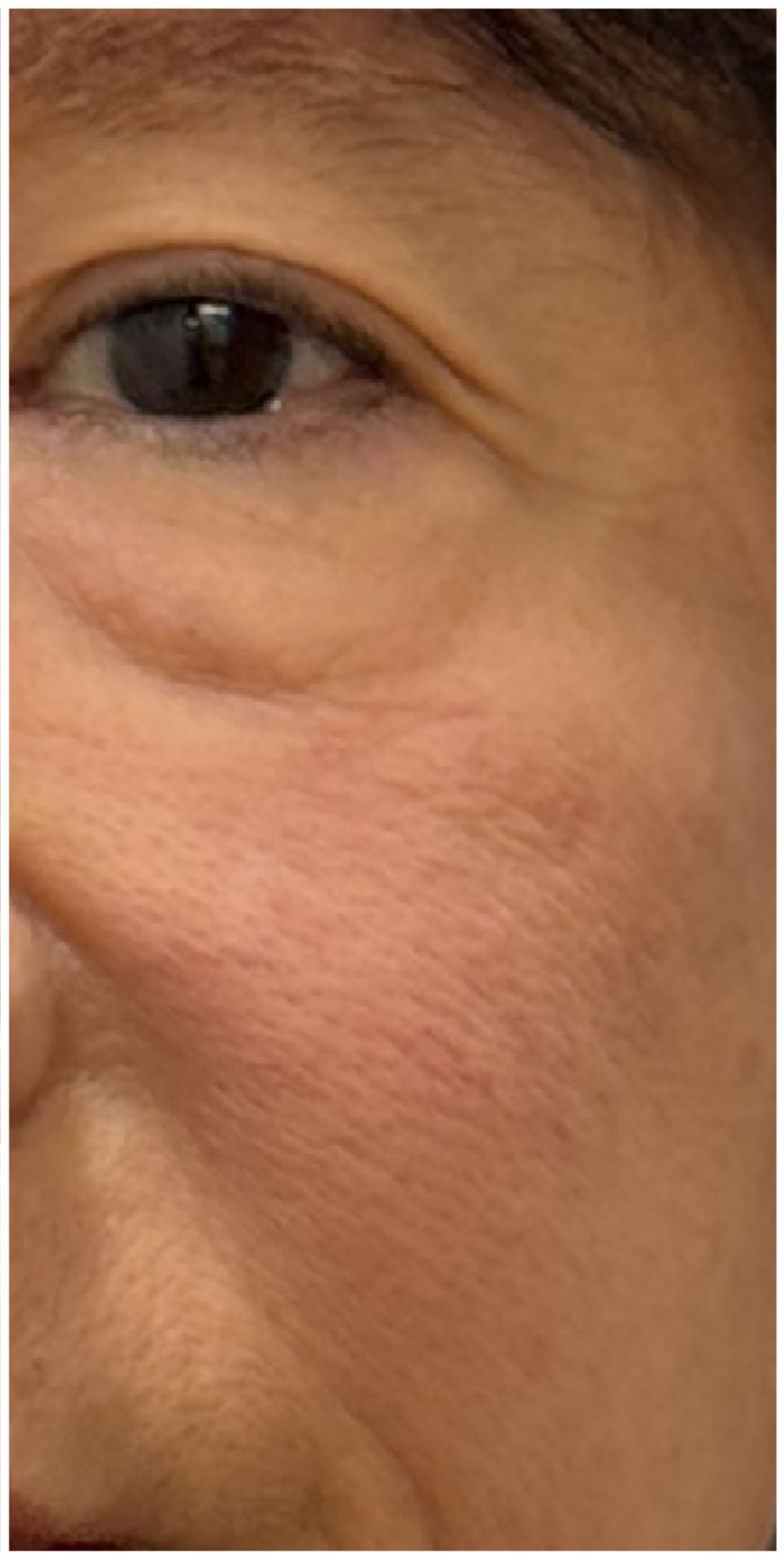IPL Photofacial after — Rosacea, Facial Redness, Visible Vessels, Telangiectasia, front view