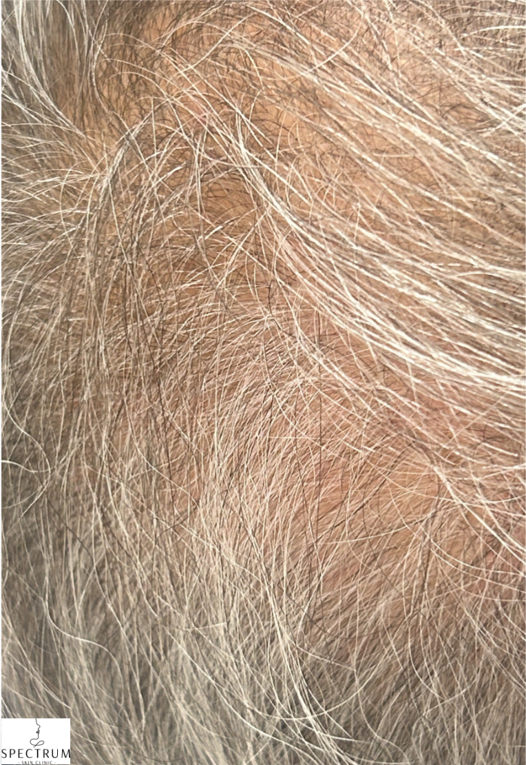 PRFM Hair Therapy before — Hair Thinning at Crown, Vertex Visibility, front view