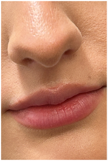 Lip Filler before — Volume Loss, front view