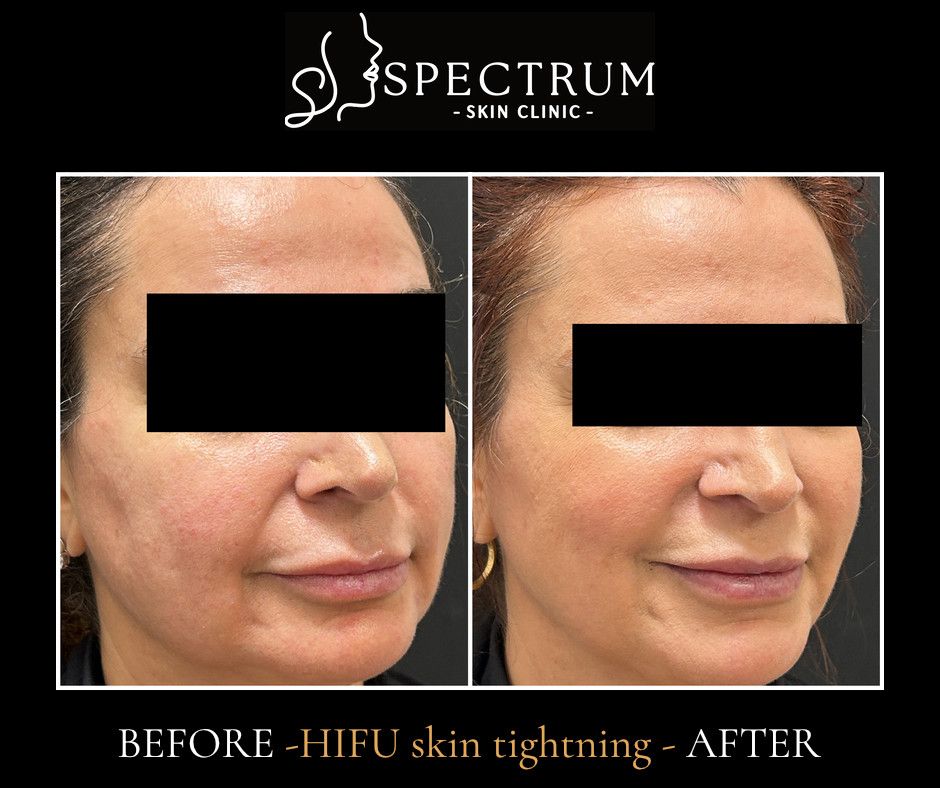 HIFU Before & After | Lower-Face and Midface Skin Tightening (Oblique View)