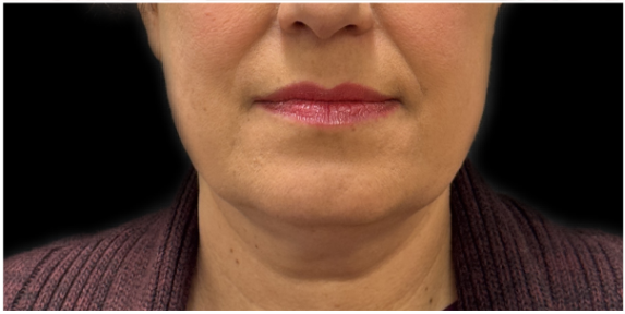 Kybella after — Double Chin, Submental Fullness, Submental Fat, front view