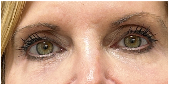 eMatrix Sublative RF, Rejuran after — Periorbital Fine Lines, Under-Eye Texture, Crepey Eyelid Skin, Dullness, front view