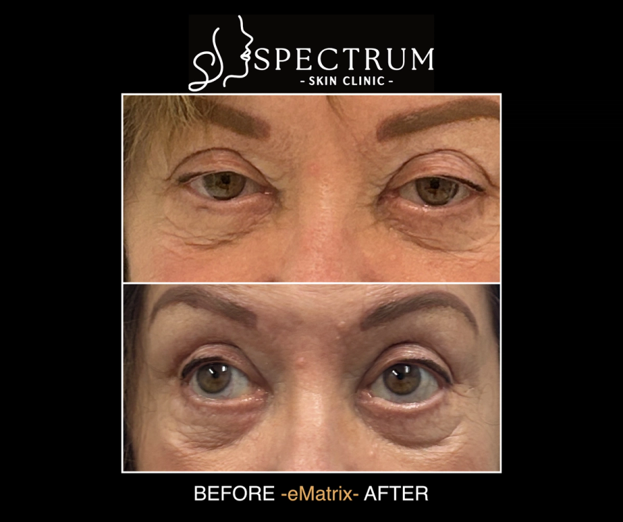 eMatrix Under Eye Before & After, Sublative Resurfacing for Mature Periorbital Skin at Spectrum Skin Clinic, Irvine