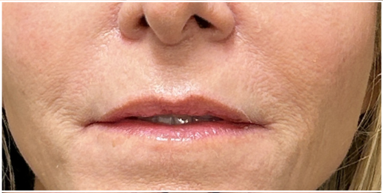 Restylane before — Smoker Lines, Perioral Lines, Vertical Lip Lines, Fine Lines and Wrinkles, Lip Definition, front view