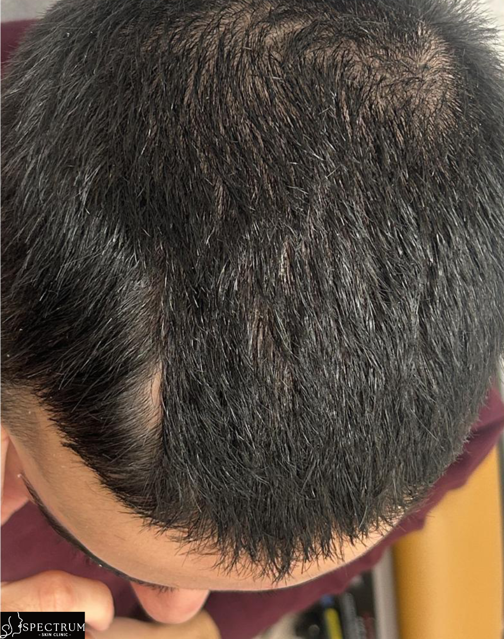 Exosome Therapy before — Crown Thinning, Chronic Hair Shedding, front view