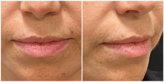 Lip Filler before — Thin Lips, Perioral Aging, Lip Lines, Fine Lines, Wrinkles, front view