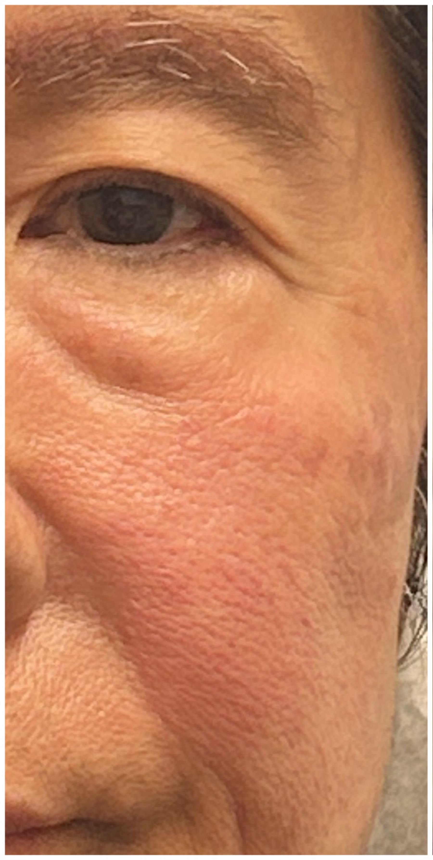 IPL Photofacial before — Rosacea, Facial Redness, Visible Vessels, Telangiectasia, front view