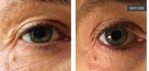 Laser Under-Eye Tightening before — , front view