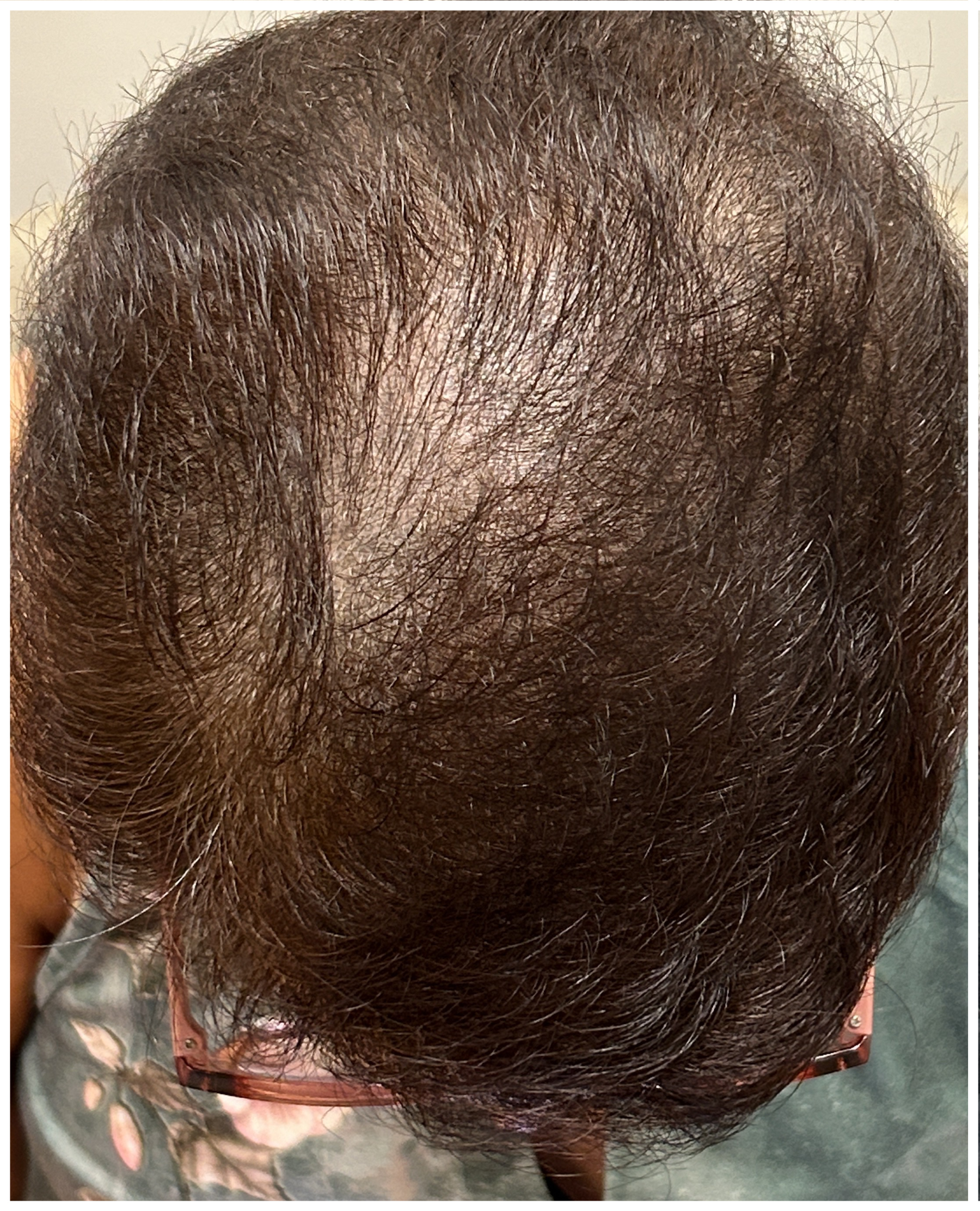 Exosome Hair Therapy before — Androgenetic Alopecia, Crown Thinning, Hair Density Loss, front view