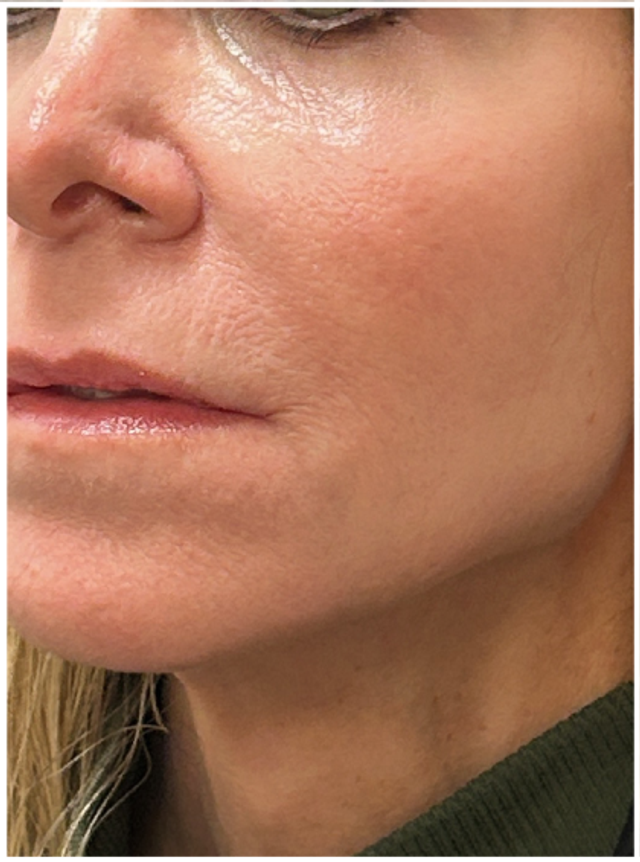 CO2 Laser Resurfacing Before & After | Skin Texture and Tone Renewal — before