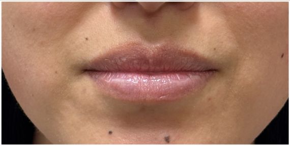 Lip Filler before — thin lips, lip volume, lip definition, vermilion border, front view