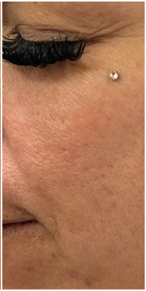 Microneedling with TCA CROSS Peel after — Acne Scars, Boxcar Scars, Pitted Scars, Uneven Texture, Post-Acne Hyperpigmentation, front view