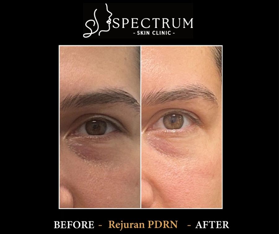 Rejuran PDRN Under Eye Before & After | Salmon DNA Skin Booster