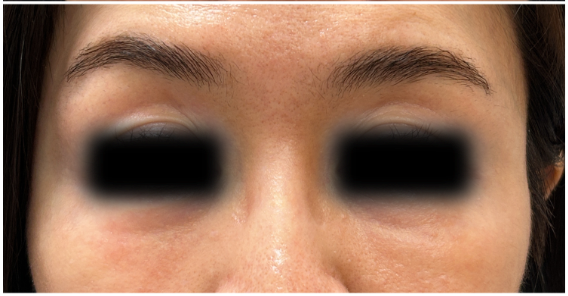 Under Eye Filler Dissolve after — Tyndall Effect, Under Eye Bags and Puffiness, Under Eye Hollows, Filler Migration, front view