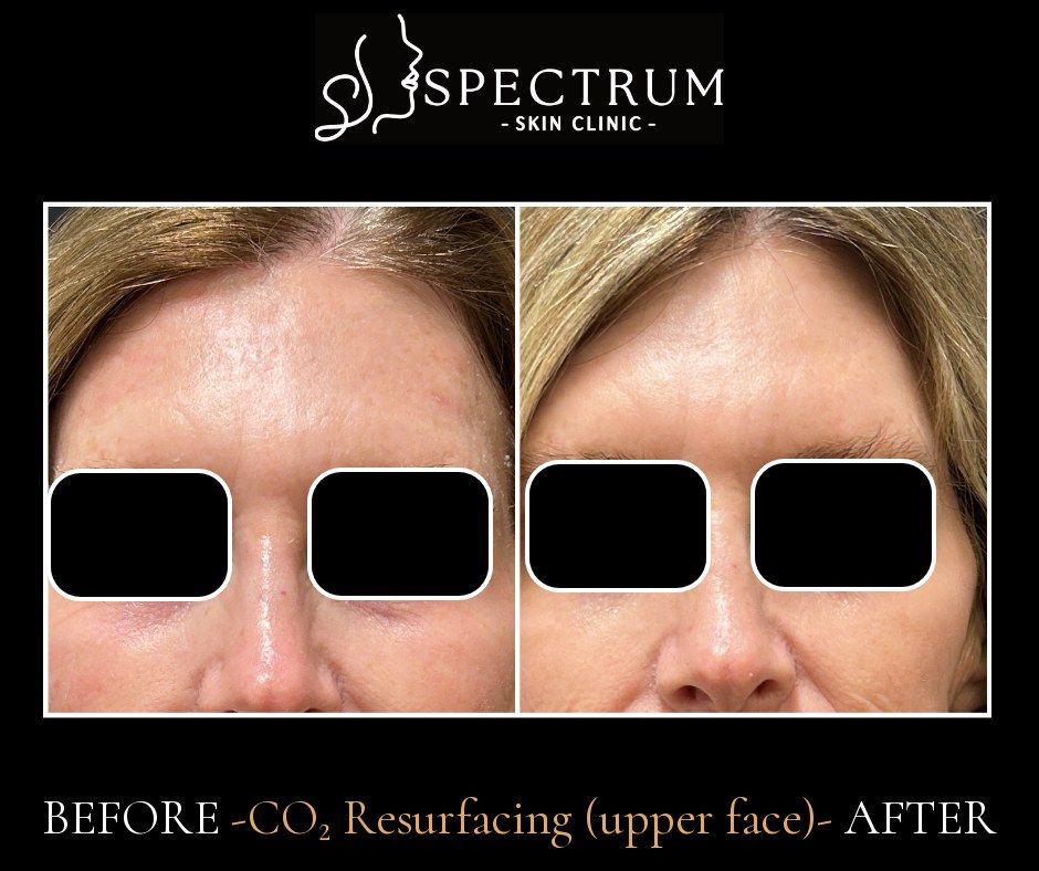 CO2 Laser Before & After | Upper Face Lines and Texture