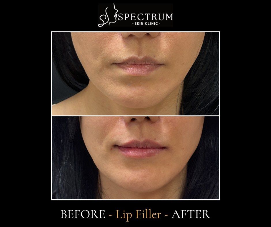 Lip Filler Before & After | Upper Lip Volume and Border