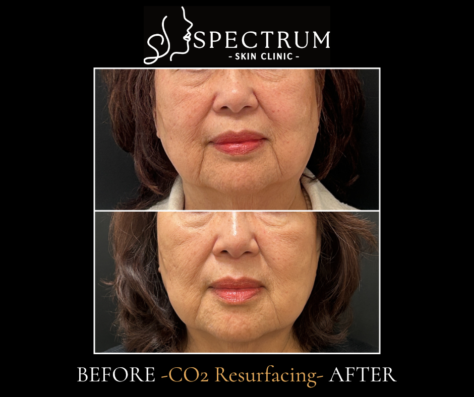 Laser Skin Resurfacing Before & After | CO2 for Fine Lines and Skin Tightening