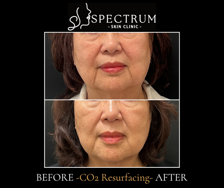 Laser Skin Resurfacing Before & After | CO2 for Fine Lines and Skin Tightening