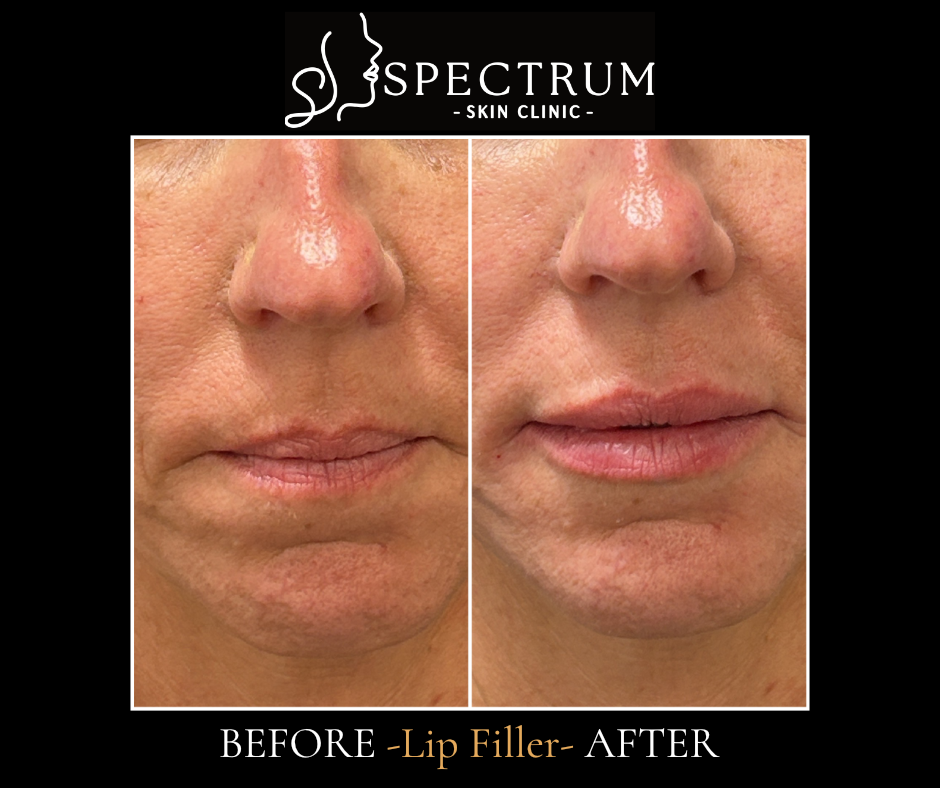 Lip Filler Before & After | Natural Volume and Definition