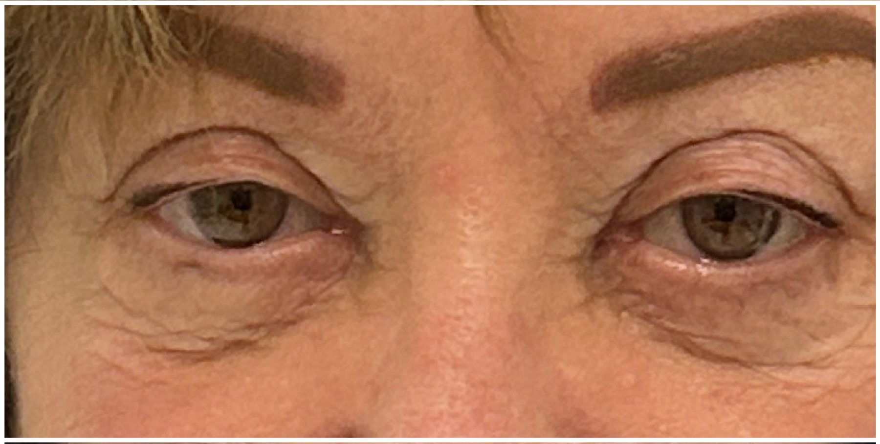 eMatrix Sublative before — Fine Lines and Wrinkles, Crepey Eyelid Skin, Uneven Texture, front view
