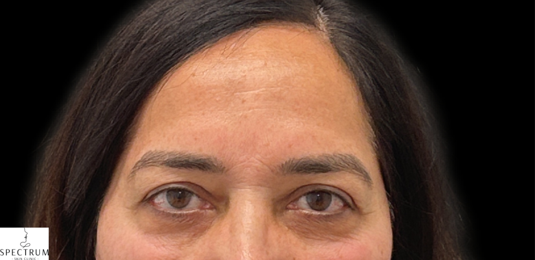 dysport after — fine-lines-wrinkles, front view