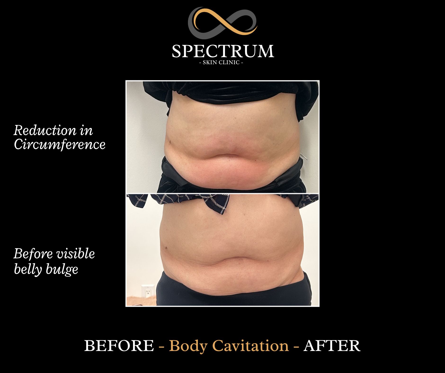 ultrasonic cavitation treatments and b12 injections Serenity Skin NY