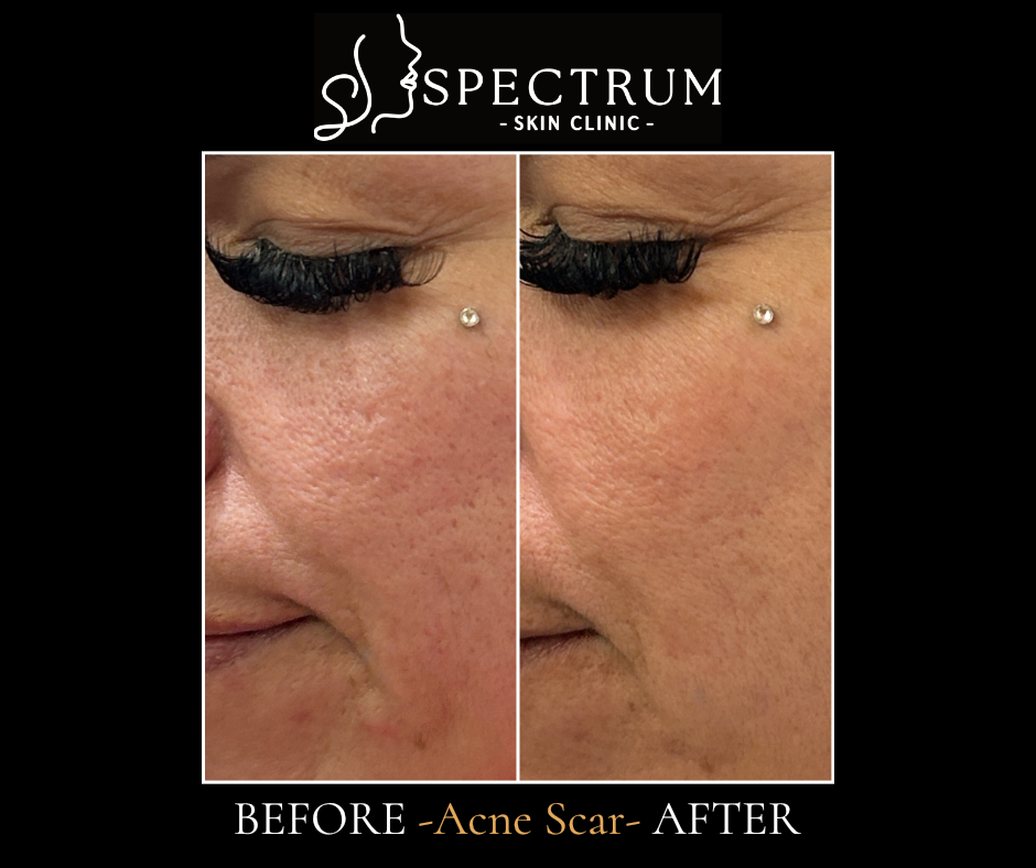 Microneedling with TCA CROSS Before & After | Acne Scar Texture Refinement